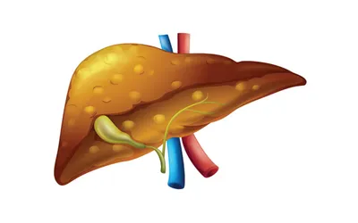 silent threat  fatty liver disease in kashmir