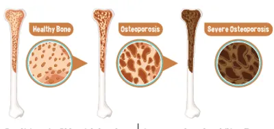 keeping healthy as we age    sarcopenia and osteoporosis