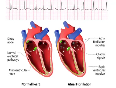 atrial fibrillation  af   the commonest serious palpitation