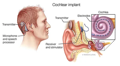 cochlear implants