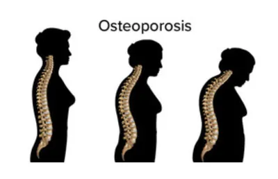 dietary deficiency major risk factor for osteoporosis in women  experts