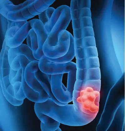 colorectal cancer prevention and treatment