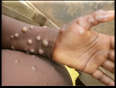 mpox impacting a broader demographic  warns lancet report