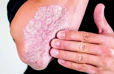 understanding psoriasis