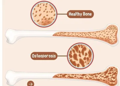 osteoporosis  a silent bone thief in elderly