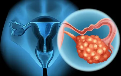 why gynaecological cancers are rising among young indian women