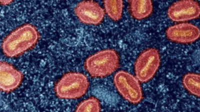 us confirms first case of clade i mpox in california