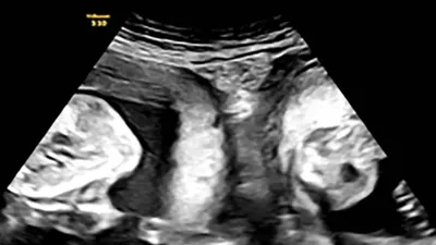 one from each womb  woman with double uterus gives birth to twins