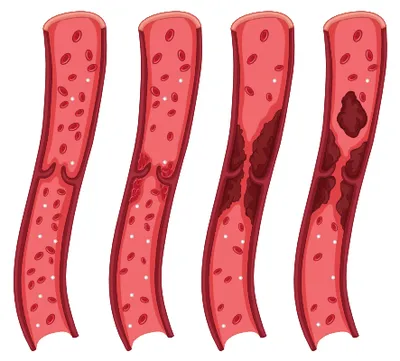 e thrombosis  a modern health concern