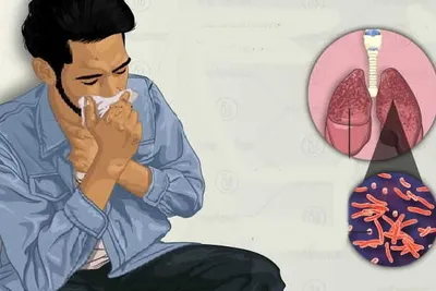 indian startup to detect tb based on cough sounds with google’s ai model