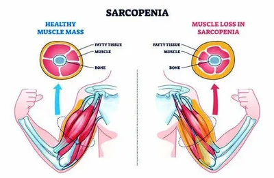 sarcopenia  age related muscle loss