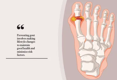 understanding gout  causes  symptoms and management